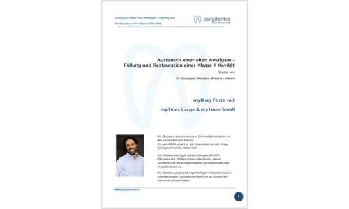 Dr. Giuseppe Chiodera – Austausch einer alten Amalgam – Füllung und Restauration einer Klasse II Kavität – myQuickmat Forte kit