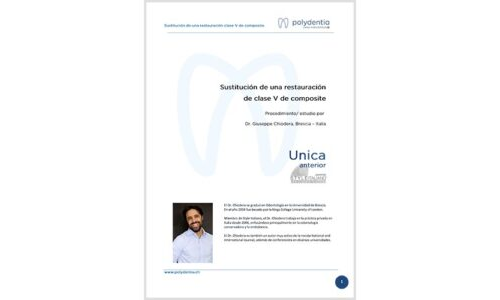 Dr. Giuseppe Chiodera – Sustitución de una restauración de clase V de composite – Unica anterior