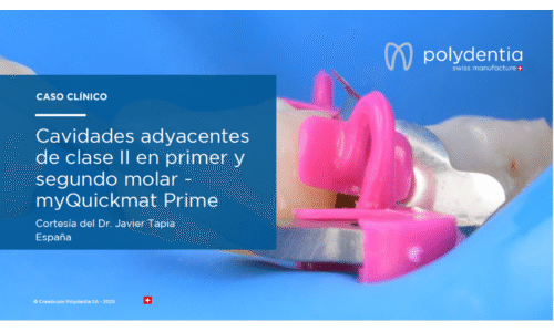 Dr Javier Tapia - Cavidades adyacentes de clase II en primer y segundo molar myQuickmatPrime