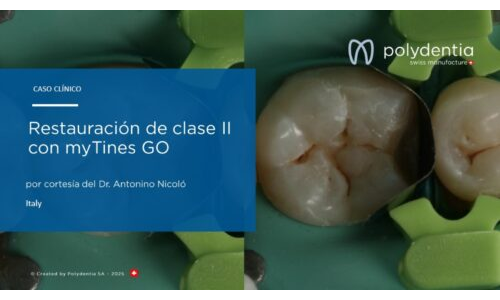 Dr Antonino Nicolo - Restauración de clase II con myTines GO