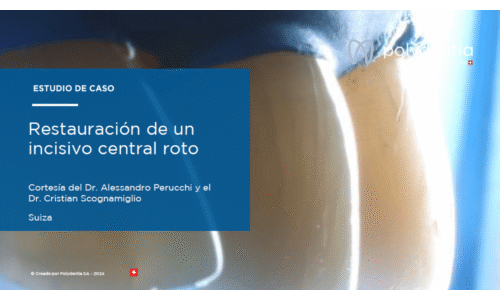 Dr Scognamiglio - Dr Perucchi - Restauración de un incisivo central roto