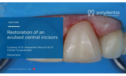 Dr Scognamiglio - Dr Perucchi - Restoration of an avulsed central incisors