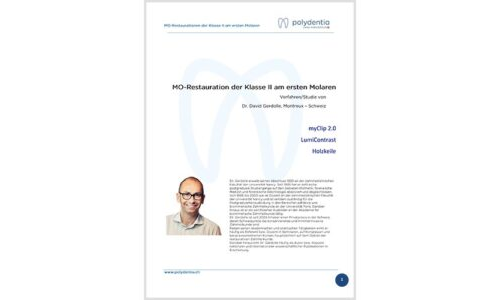 Dr. David Gerdolle – MO-Restauration der Klasse II am ersten Molaren – myClip 2.0