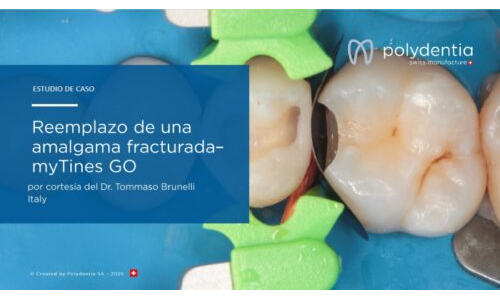 Dr Tommaso Brunelli -Reemplazo de una amalgama fracturada – myTines GO