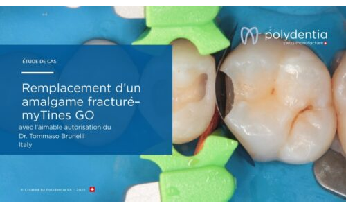 Dr Tommaso Brunelli -Remplacement d’un amalgame fracturé – myTines GO