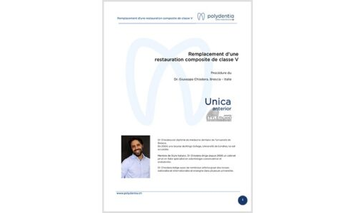 Dr. Giuseppe Chiodera – Remplacement d’une restauration composite de classe V – Unica anterior