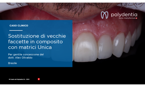 Dr Alex Olivaldo - Sostituzione di vecchie faccette in composito con matrici Unica