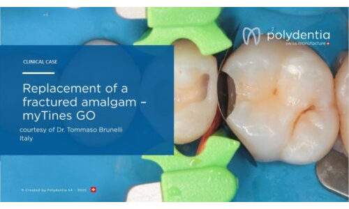 Dr Tommaso Brunelli -Replacement of a fractured amalgam –myTines GO
