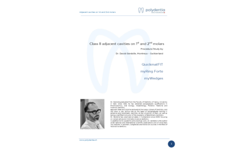Dr. David Gerdolle - Class II adjacent cavities on 1st and 2nd molars  with QuickmatFIT