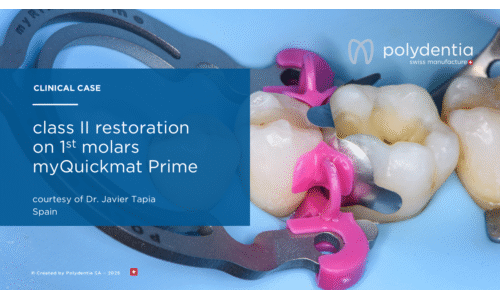 Dr Javier Tapia - class II restoration on 1st molar with myQuickmat Prime