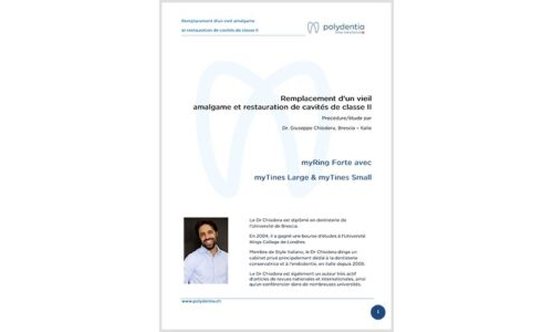 Dr. Giuseppe Chiodera – Remplacement d’un vieil amalgame et restauration de cavités de classe II – myQuickmat Forte kit
