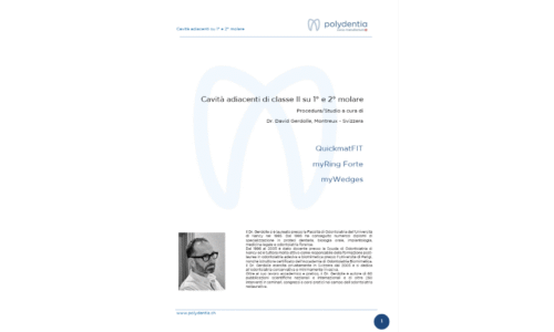 Dr. David Gerdolle - Cavità adiacenti di classe II su primo e secondo molare con matrice sezionale anatomica QuickmatFIT