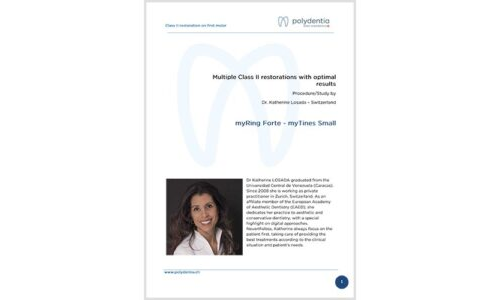 Dr. Katherine Losada – Multiple Class II restorations with optimal results – myQuickmat Forte kit