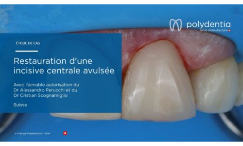 Dr Scognamiglio - Dr Perucchi - Restauration d'une incisive centrale avulsée