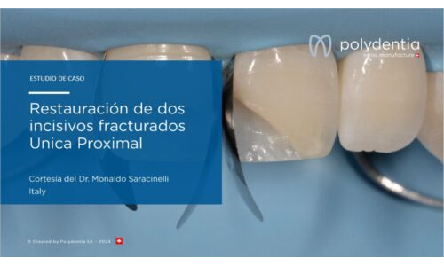 Dr Monaldo Saracinelli - Restauración de dos incisivos fracturados  Unica Proximal