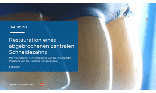 Dr Scognamiglio - Dr Perucchi - Restauration eines abgebrochenen zentralen Schneidezahns