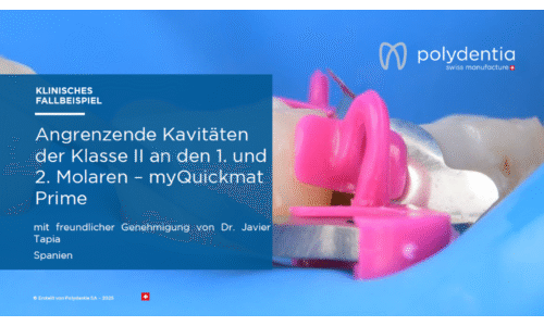 Dr Javier Tapia - Angrenzende Kavitäten der Klasse II an den 1. und 2. Molaren – myQuickmat Prime