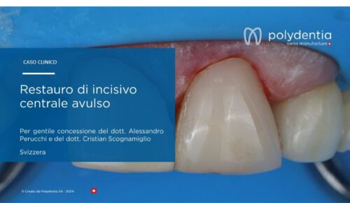 Dr Scognamiglio - Dr Perucchi - Restauro di incisivo centrale avulso