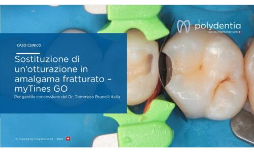 Dr Tommaso Brunelli -Sostituzione di un’otturazione in amalgama fratturato–myTines GO