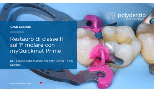 Dr Javier Tapia - Restauro di classe II sul 1° molare myQuickmatPrime