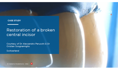 Dr Scognamiglio - Dr Perucchi - Restoration of a broken central incisor