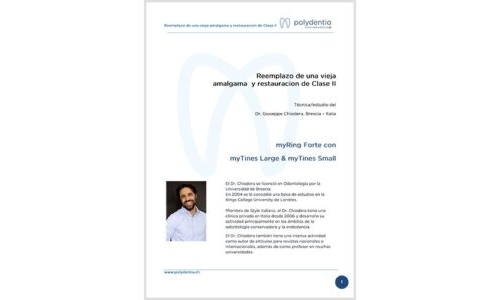Dr. Giuseppe Chiodera – Reemplazo de una vieja amalgama y restauración de Clase II – Quickmat Forte kit