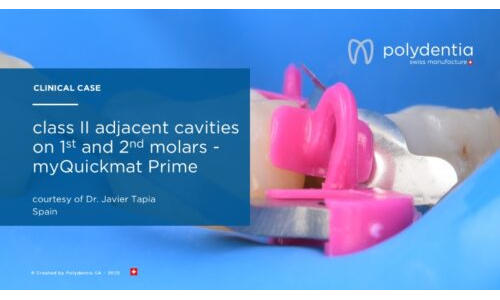 Dr Javier Tapia - Class II adjacent cavities  on 1st and 2nd molars with myQuickmat Prime