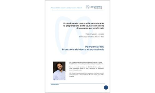 Dr. Giuseppe Chiodera –Protezione del dente adiacente – PolydentiaPRO matrice di protezione interprossimale
