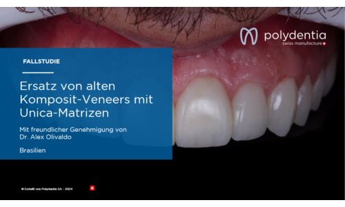 Dr Alex Olivaldo - Ersatz von alten Komposit-Veneers mit Unica-Matrizen
