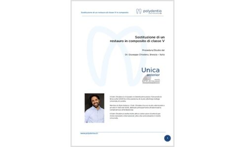 Dr. Giuseppe Chiodera – Sostituzione di un restauro di classe V in composito – Unica anterior