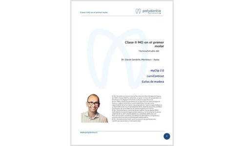 Dr. David Gerdolle – Clase II MO en el primer molar – myClip 2.0