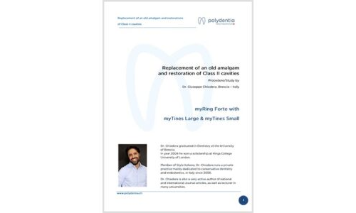 Dr. Giuseppe Chiodera – Replacement of an old amalgam and restoration of Class II cavities – myQuickmat Forte kit