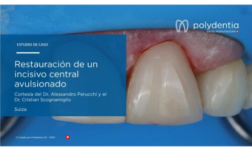 Dr Scognamiglio - Dr Perucchi - Restauración de un incisivo central avulsionado