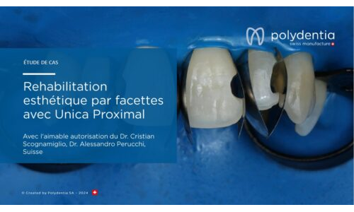 Dr Scognamiglio - Dr Perucchi - Rehabilitation esthétique par facettes avec  Unica Proximal