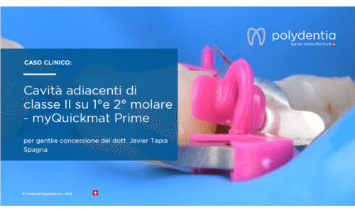 Dr Javier Tapia - Cavità adiacenti di classe II su 1°e 2°molare myQuickmatPrime