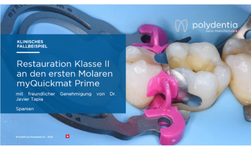 Dr Javier Tapia - Restauration Klasse II  an den ersten Molaren myQuickmat Prime