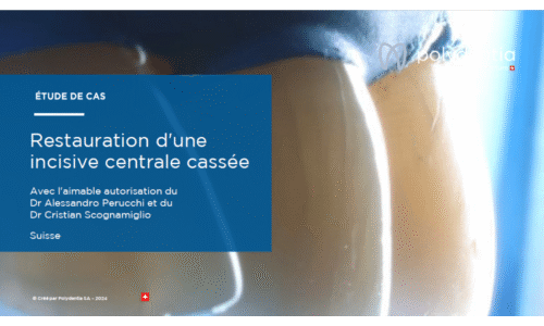 Dr Scognamiglio - Dr Perucchi - Restauration d'une incisive centrale cassée