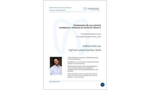 Dr. Giuseppe Chiodera – Sostituzione di una vecchia amalgama e restauro di cavità di Classe II – myQuickmat Forte kit