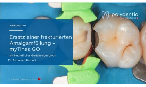 Dr Tommaso Brunelli -Ersatz einer frakturierten Amalgamfüllung –myTines GO